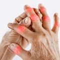 Understanding the Side Effects of Arthritis Therapy