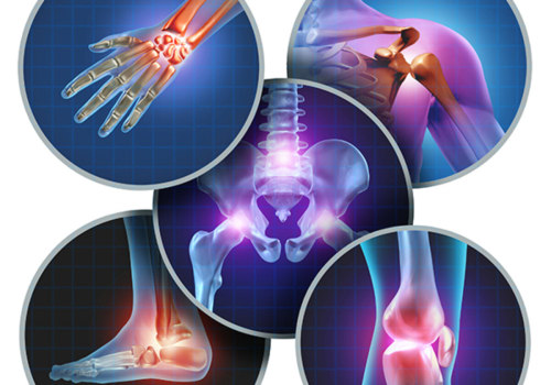 Exploring Surgical Options for Severe Arthritis: A Comprehensive Look at Arthritis Therapy